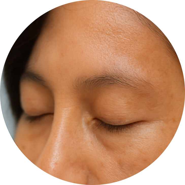 난치성 색소 질환