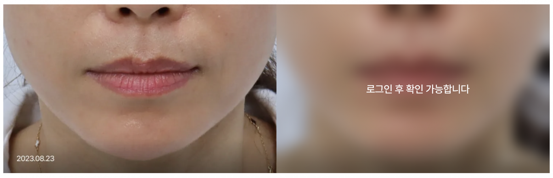 Titanium 시술 전후